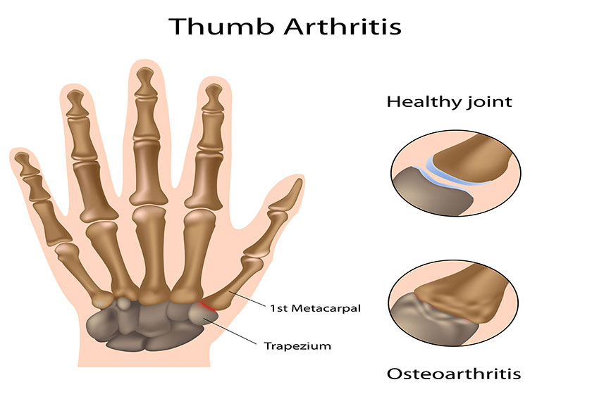 Is Arthritis Normal With Aging? Morada Senior Living