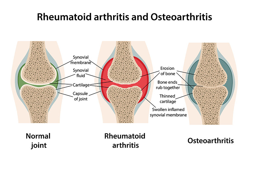 Rheumatoid Arthritis And Osteoarthritis What Is Common And 41 OFF